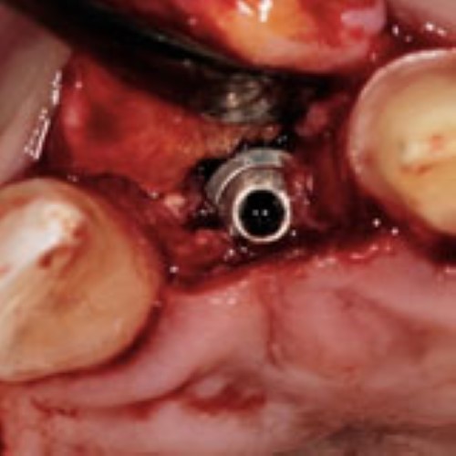 Implant uncoverage in esthetic areas - clinical strategies